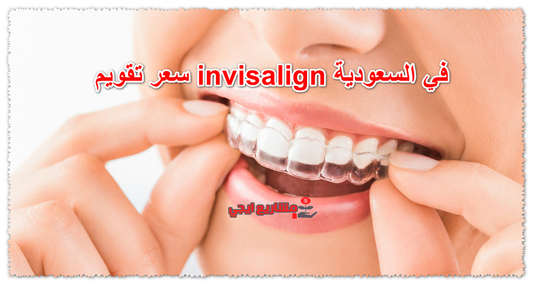 سعر تقويم invisalign في السعودية